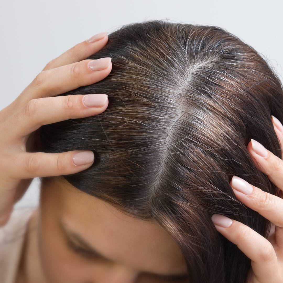 Veränderungen der Kopfhaut und Haardichte im Laufe der Zeit Nahaufnahme des Scheitels einer Frau, die ihre Hände an den Kopf legt, um den Haaransatz mit ersten grauen Haaren und die Kopfhaut zu zeigen.